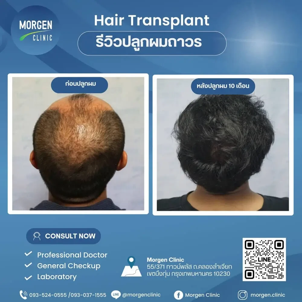 ปลูกผมที่ไหนดี ปลูกผมถาวร Morgen