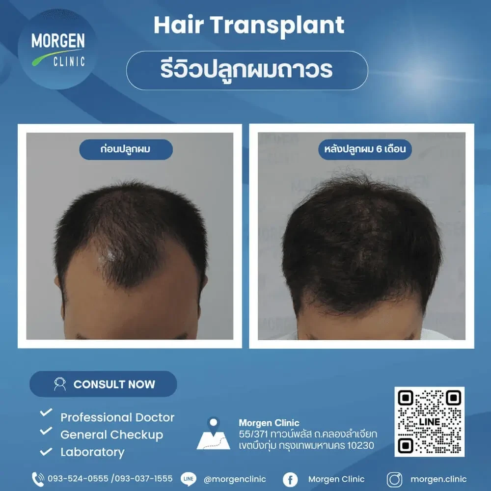 ปลูกผมที่ไหนดี หัวล้านกลับมาหนา