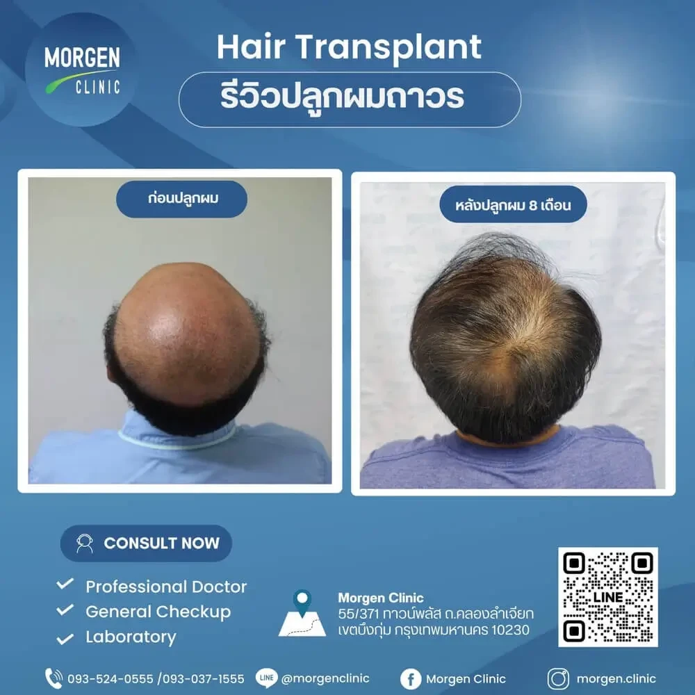 ปลูกผมที่ไหนดี ปลูกผมถาวร