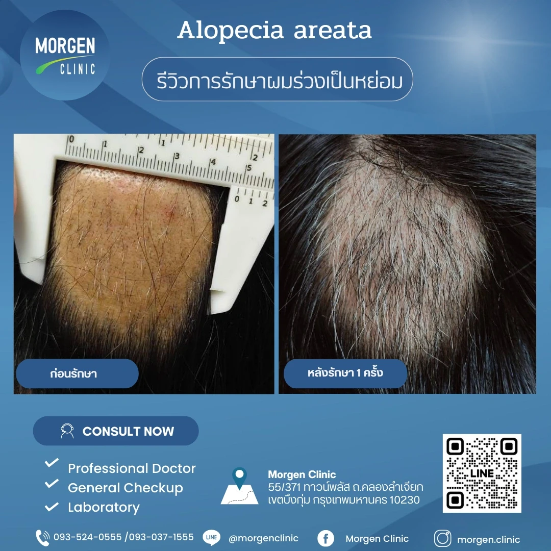 รีวิวรักษาผมร่วงเป็นหย่อม