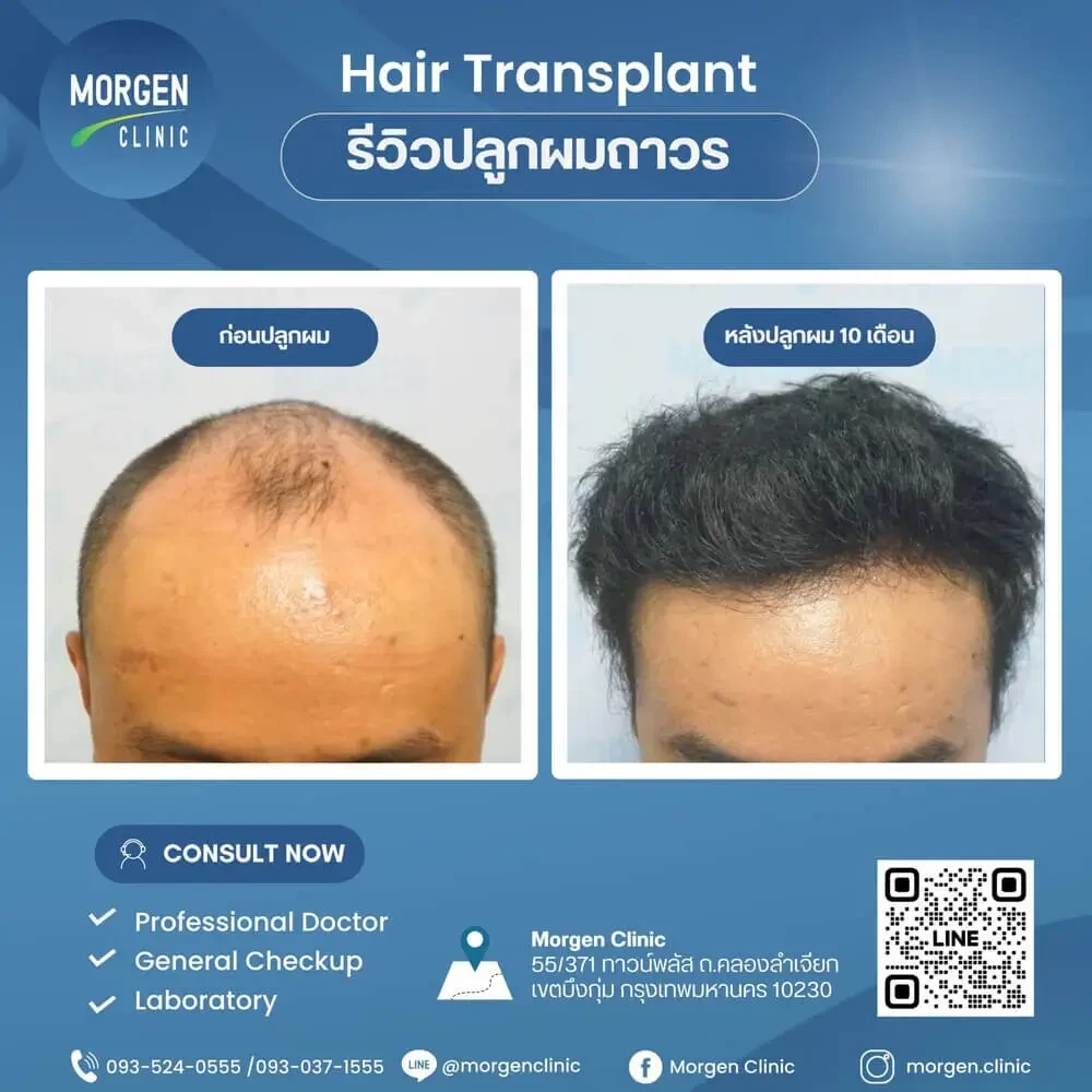 ปลูกผมที่ไหนดี หัวล้าน ปลูกผมถาวร