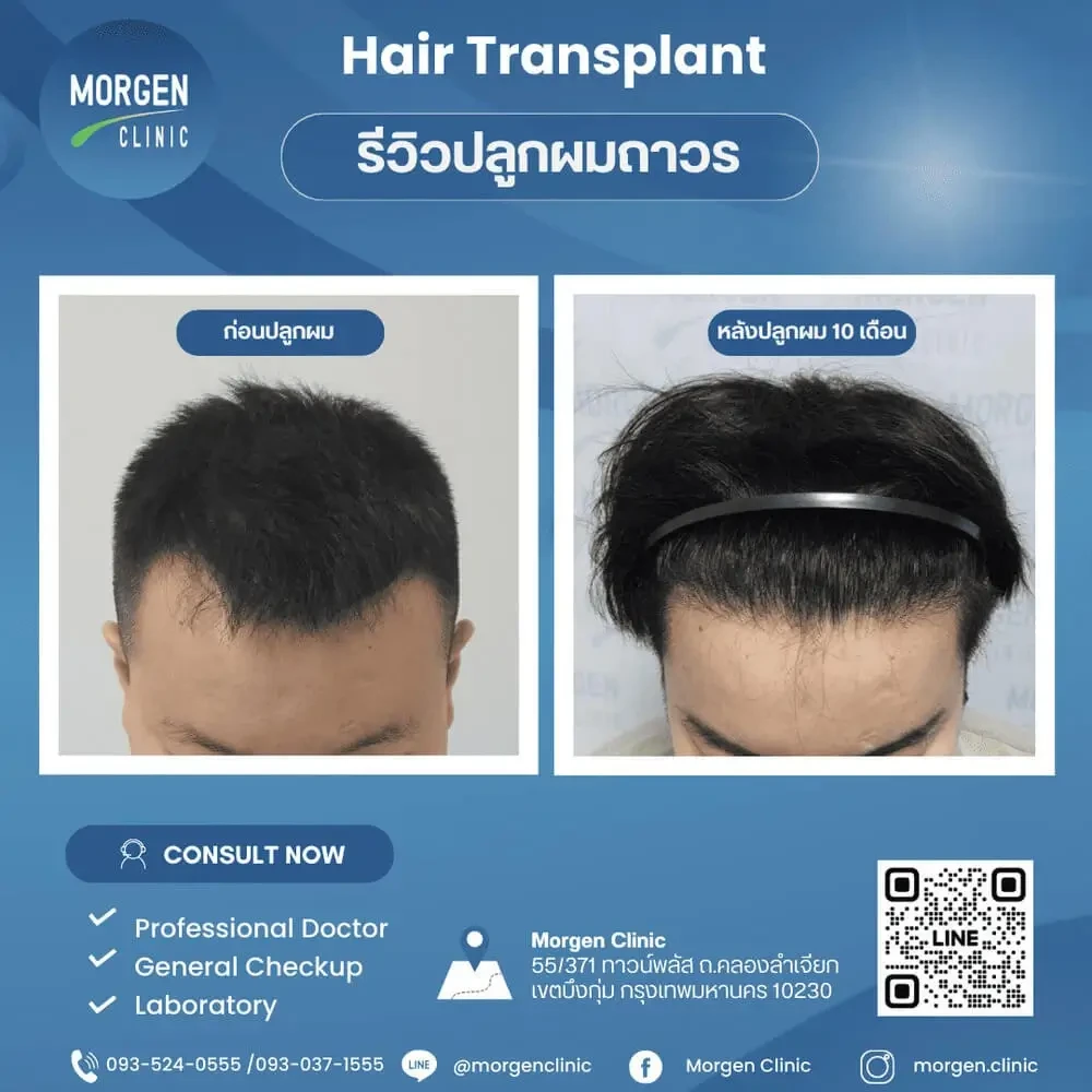 ปลูกผมที่ไหนดี ผมหนา