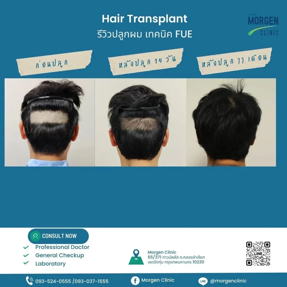 รีวิวปลูกผม FUE