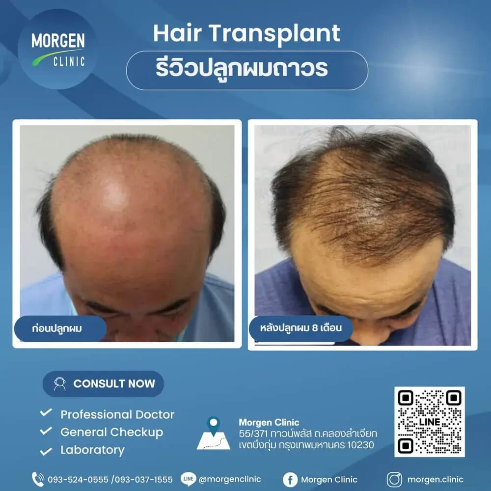 ปลูกผมที่ไหนดี ผมบาง ปลูกผมถาวร