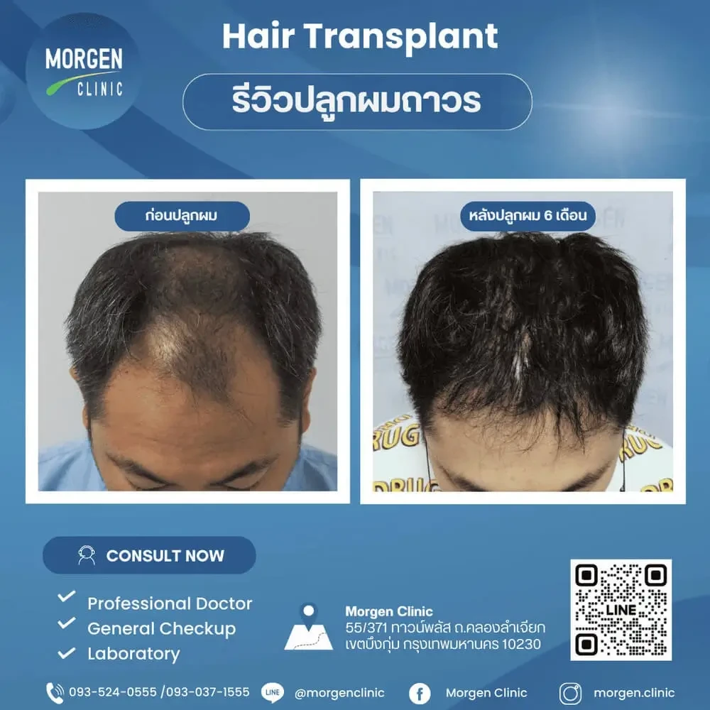ปลูกผมที่ไหนดี 6 เดือน