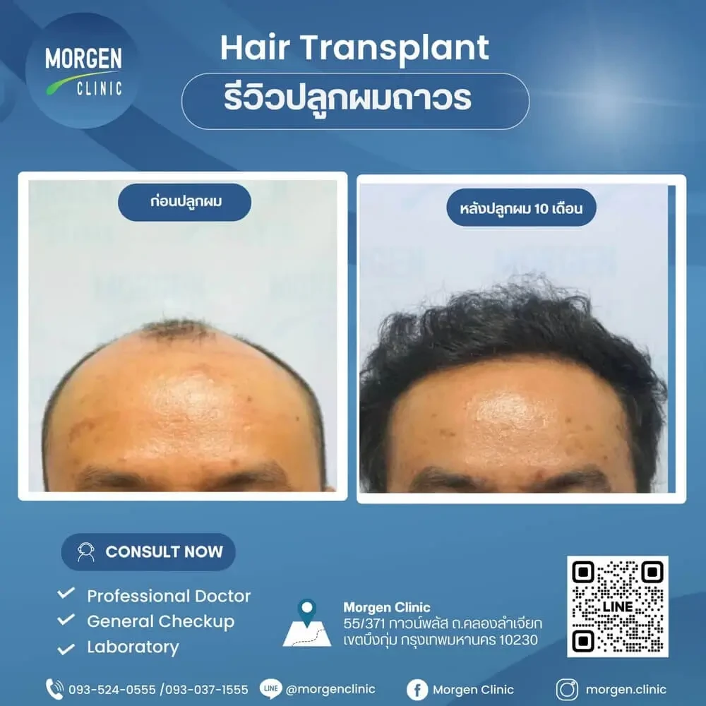 ปลูกผมที่ไหนดี หัวล้าน ผมขึ้นจริง