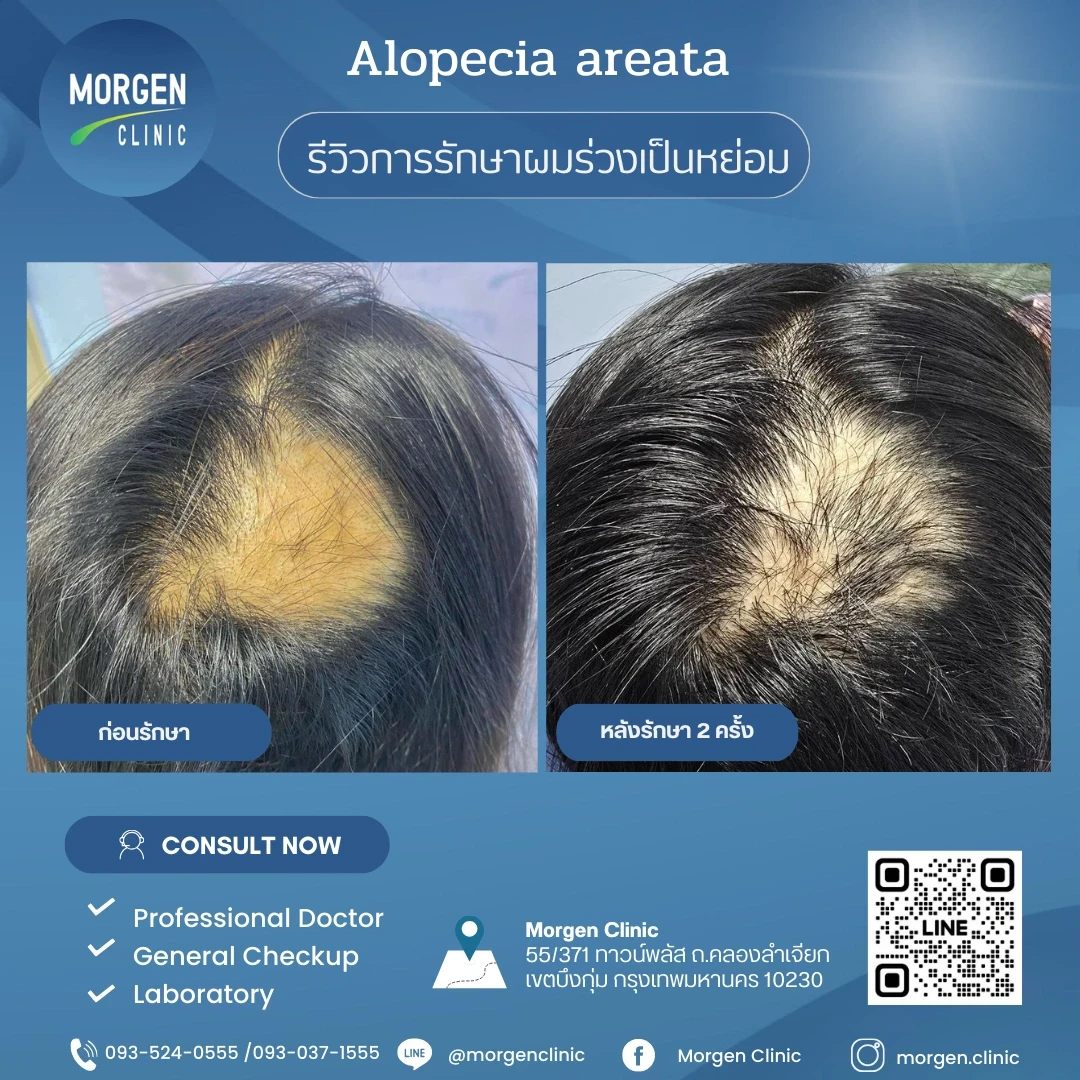 รีวิวรักษาผมร่วงเป็นหย่อม