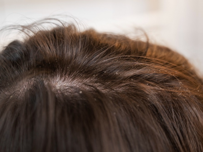 รังแคเรื้อรังแก้ได้อย่างไร? รวม "วิธีรักษารังแค" ก่อนบานปลายจนต้องพึ่ง คลินิกรักษาผมร่วง