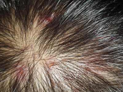 หนังหัวลอกเกิดจากอะไร? เช็กอาการให้ชัวร์ พร้อมวิธีแก้ หนังศีรษะแห้ง ลอกเป็นแผ่น